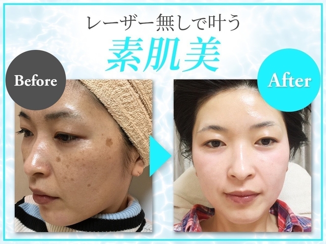 安心のレーザー不使用!!シミ肌に特化したサロン【グランシス水戸店】でシミ肌撃退！