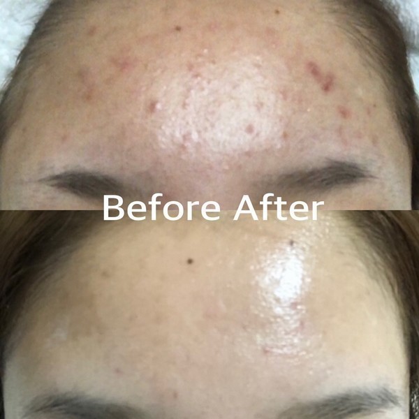 beauty salon M 肌質改善ハーブピーリング・小顔ハイフ