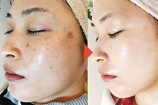 ★脱！！レーザー★シミ専門サロンの技術で成功者続々誕生｜ 学園南店｜研究学園駅前店