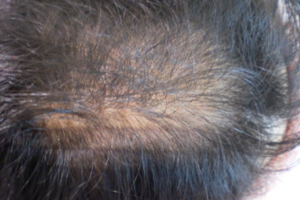 発毛実績は驚異の98％